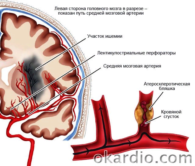https://medspina.ru/wp-content/uploads/cerebrovaskulyarnaya-bolezn.jpg