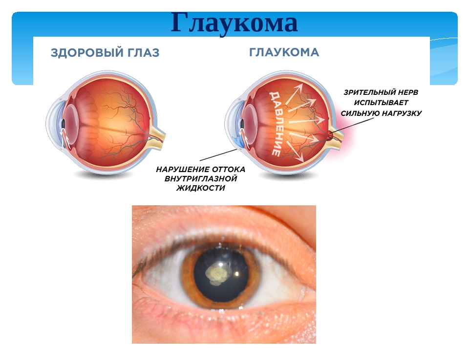 Врожденная глаукома буфтальм. Закрытоугольная глаукома глаза. Глаукома схема глаза. Глаза катаракта глаукома. Можно вернуть зрение при глаукоме