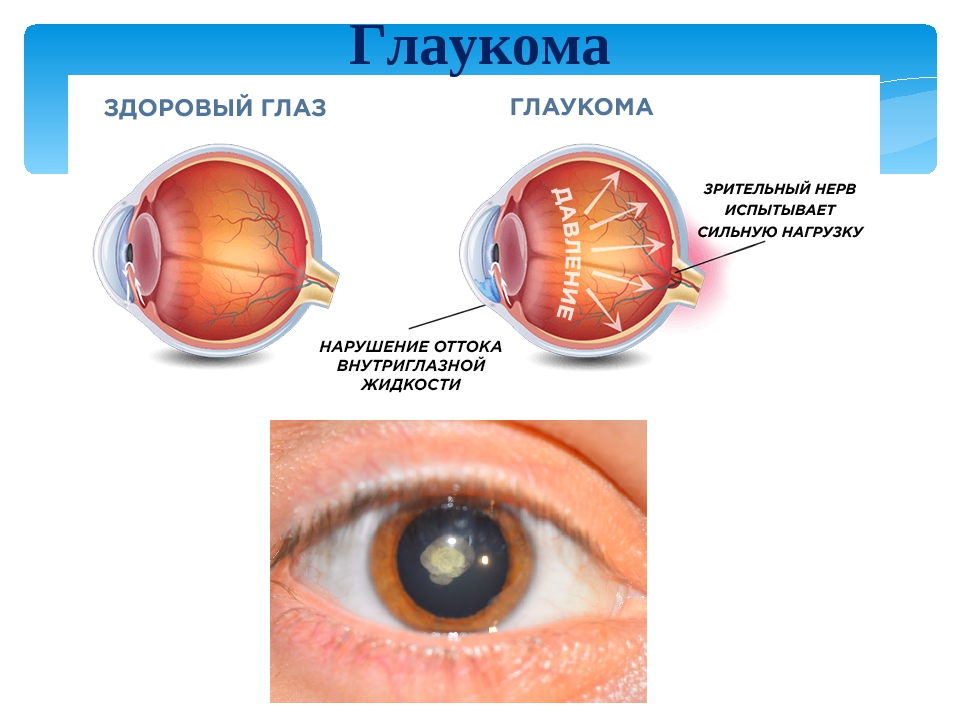 От чего появляется катаракта. Врожденная глаукома буфтальм. Закрытоугольная глаукома глаза. Глаукома схема глаза.