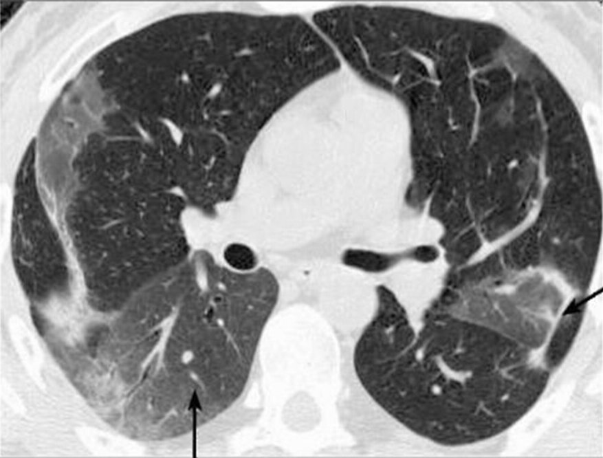 Зоны "матового стекла" можно отчетливо увидеть на снимке КТ 