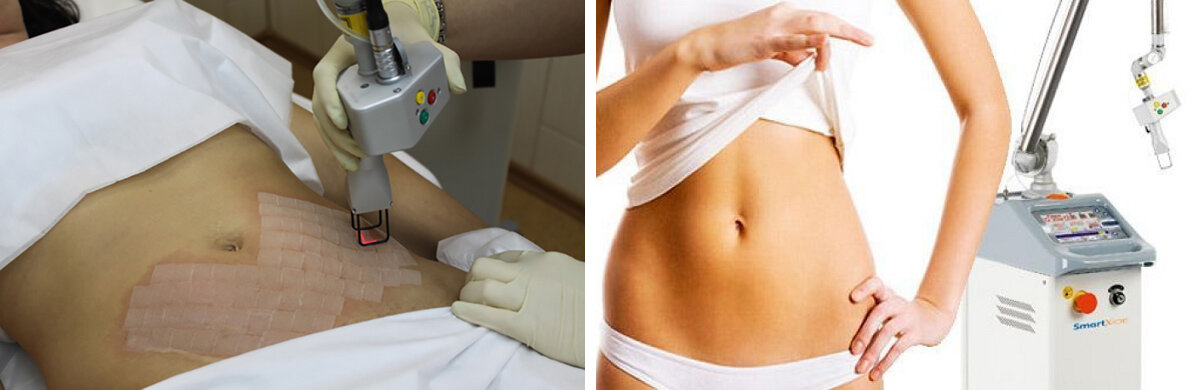 Косметологические процедуры по удалению растяжек