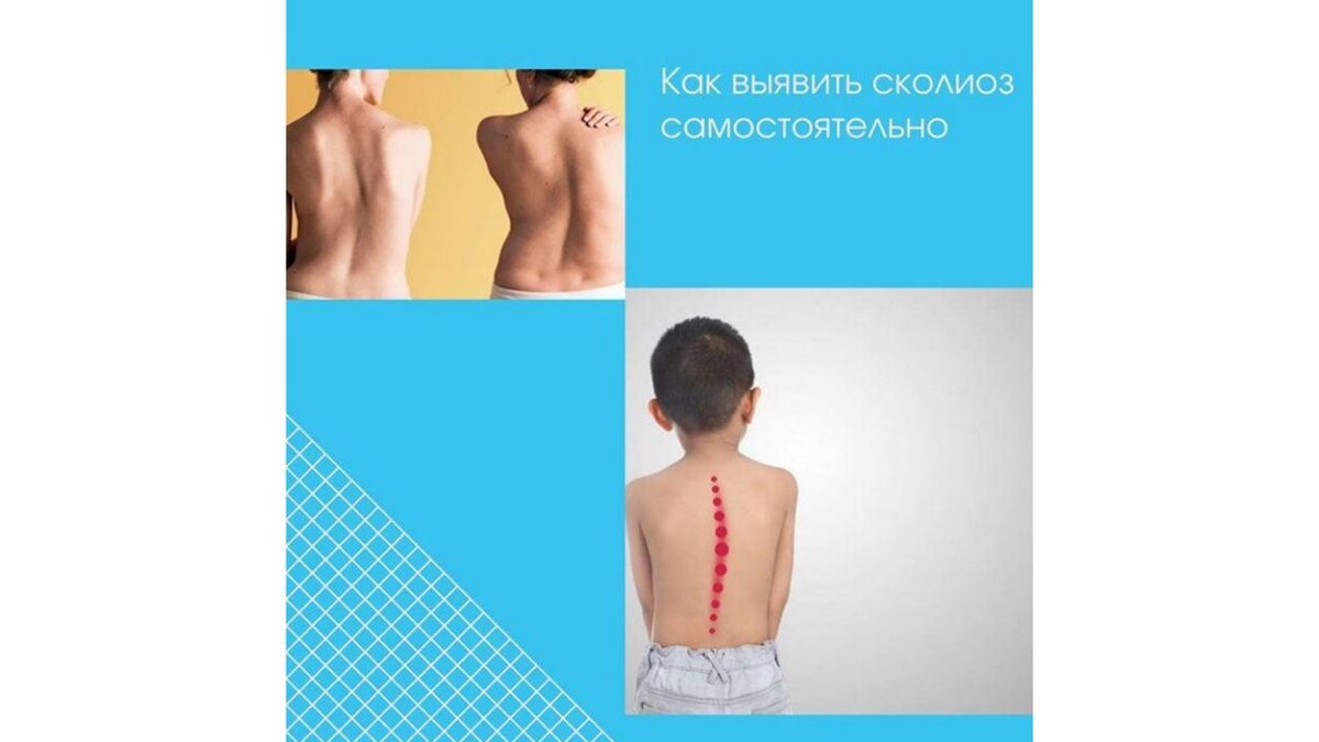 Простые, но эффективные методы обнаружения сколиоза