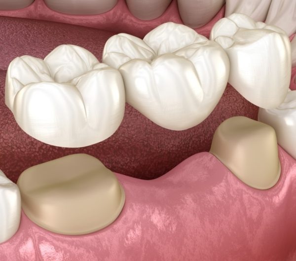 Мостовидный протез