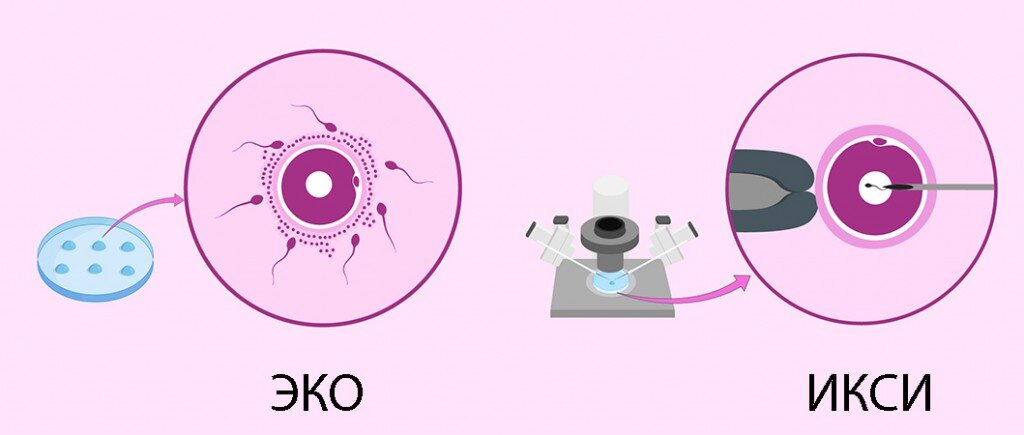 изображение из открытых источников, отличие обычного ЭКО и ЭКО с применением ИКСИ