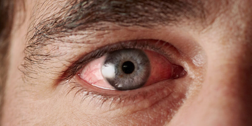 Источник:  American Academy of Ophthalmology