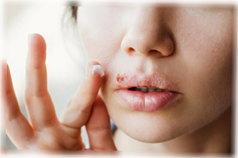 губной герпес - проблема 21 века