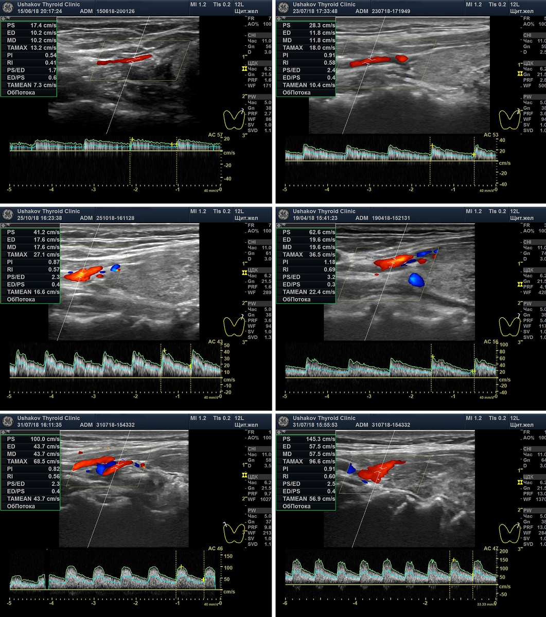 Цдк 7. Допплерография щитовидной железы. Кровоток щитовидной железы в норме на УЗИ. УЗИ щитовидной железы с цветным допплеровским картированием. УЗИ щитовидной железы в режиме ЦДК.