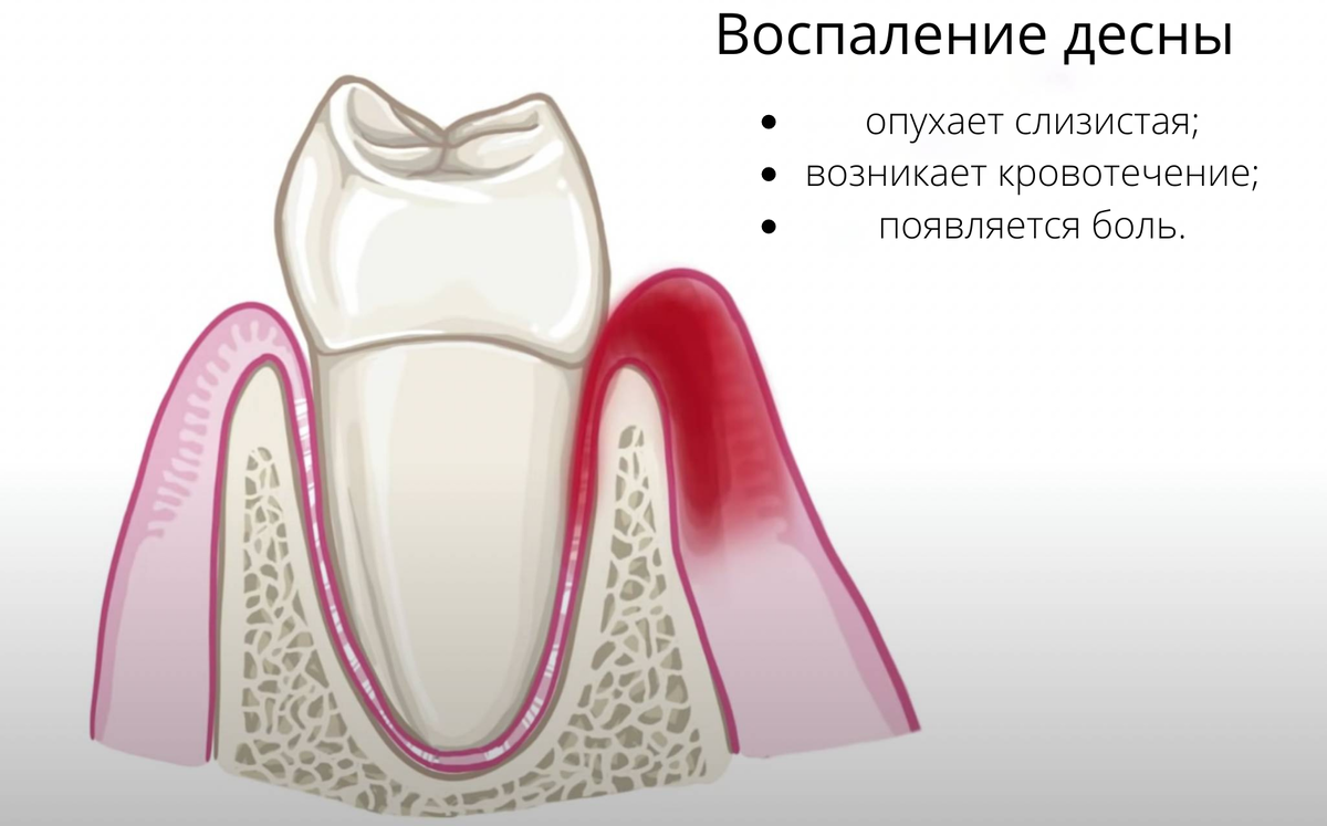 Как снять отек десны в домашних условиях Милана Камнева ВКонтакте