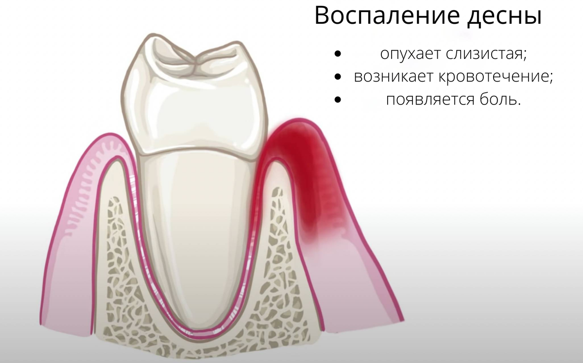 Что делать если опухла десна? Чем снять боль 👨‍⚕️ | Центр имплантации  доктора Фёдорова | Дзен