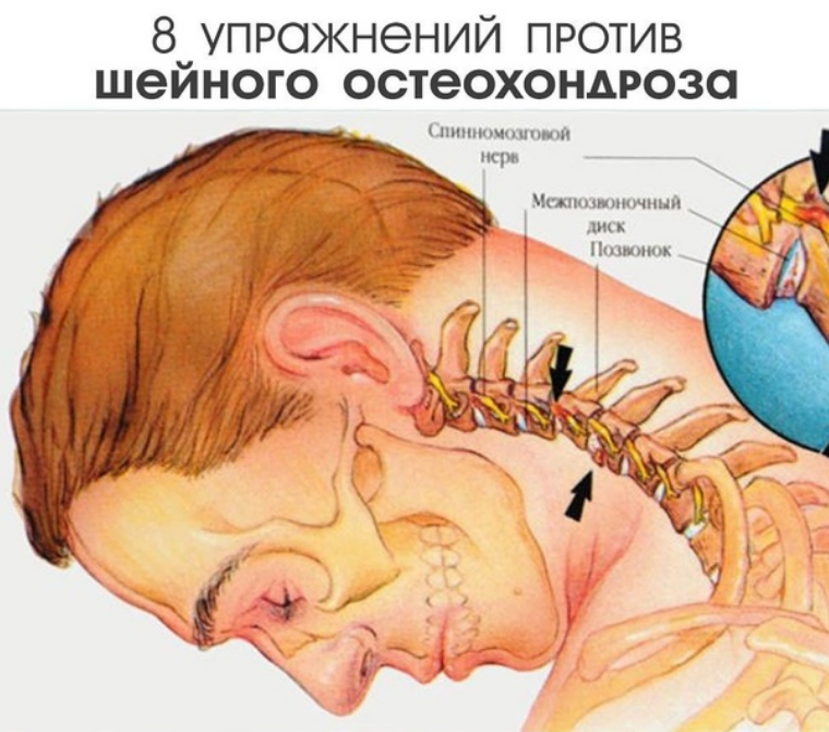 Шейный остеохондроз упражнения