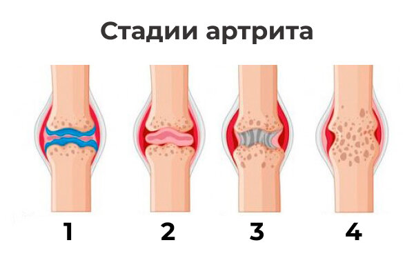 Что такое артроз 1 2 степени. Деформация суставов при остеоартрозе. Артроз коленного сустава 1 стадии. Деформирующий остеоартроз деформация суставов. Гонартроз коленного сустава степени.