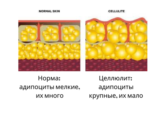 Почему целлюлит возникает у худых и как с ним бороться | Спортивные Лайфхаки | Дзен