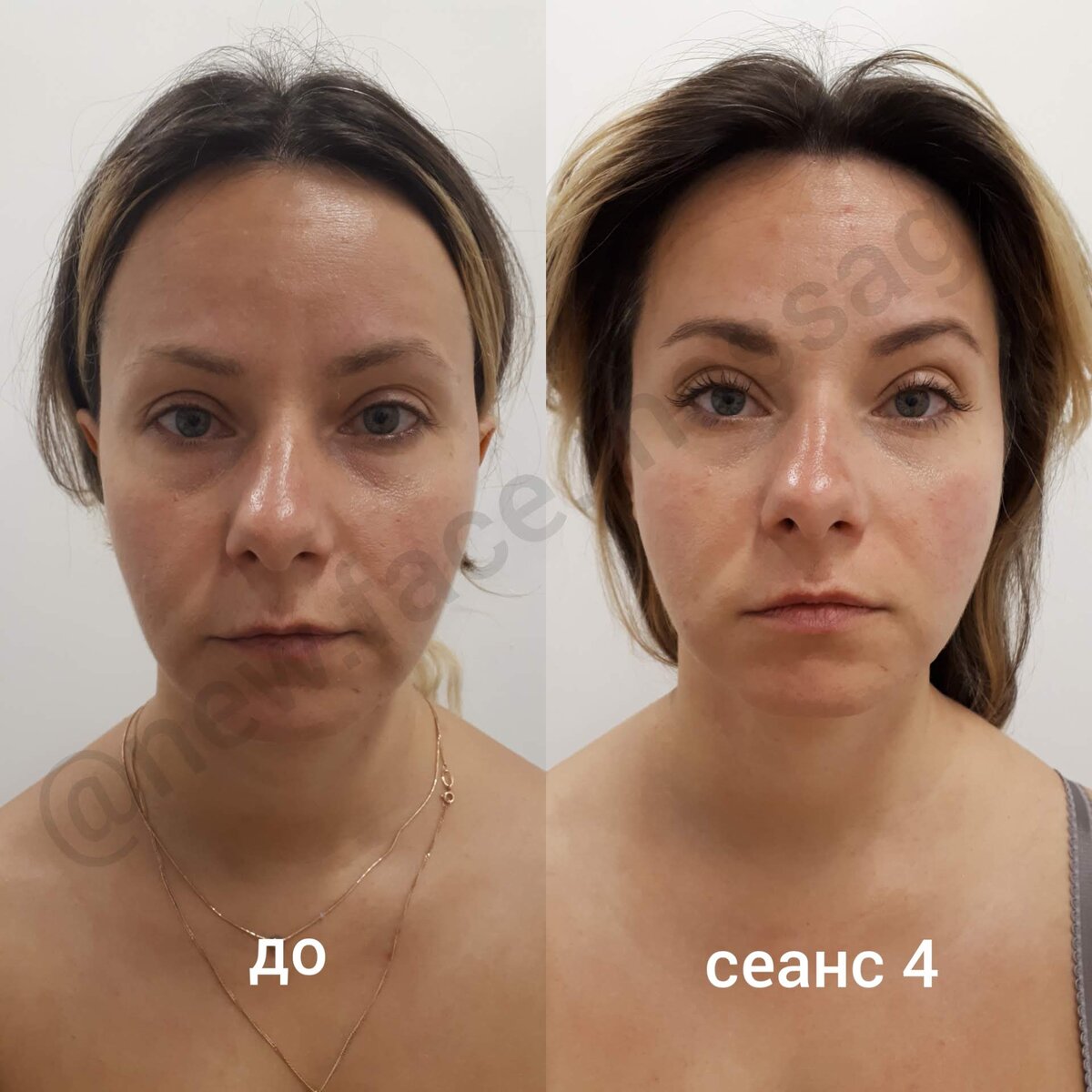 Lpg массаж лица в Кишиневе и Харькове, фото до и после, отзывы, цена |Honest Beauty