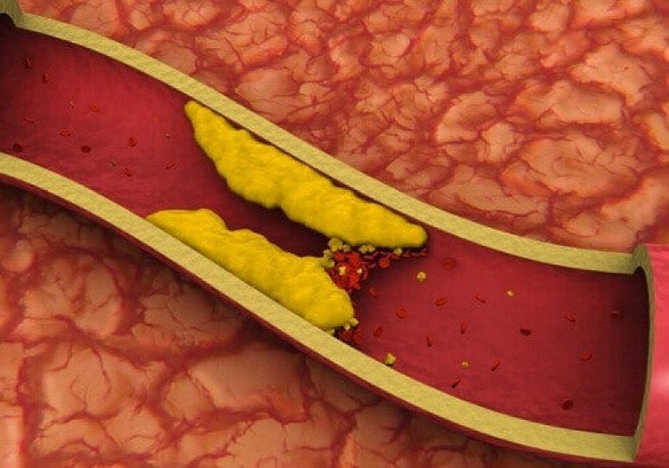 Холестерин высокое артериальное