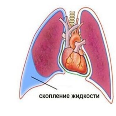 Плеврит при раке легкого - Стационар Экстрамед