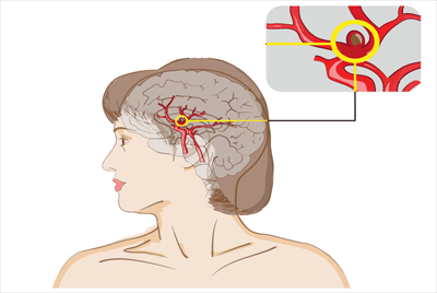 Пример аневризмы сосуда головного мозга. Фото из Яндекс.Картинки.