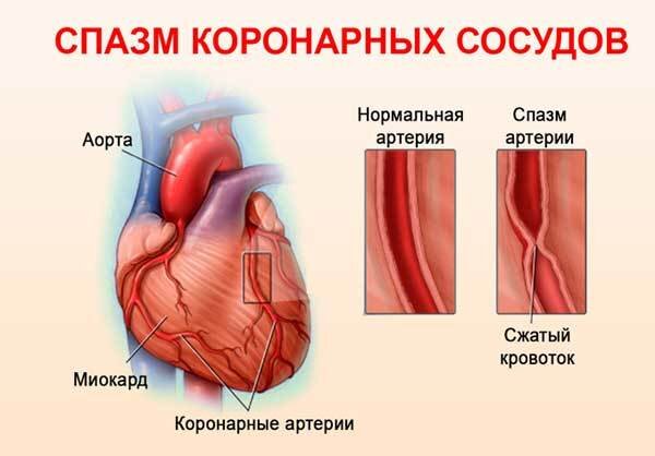 Спазм сосудов головного мозга