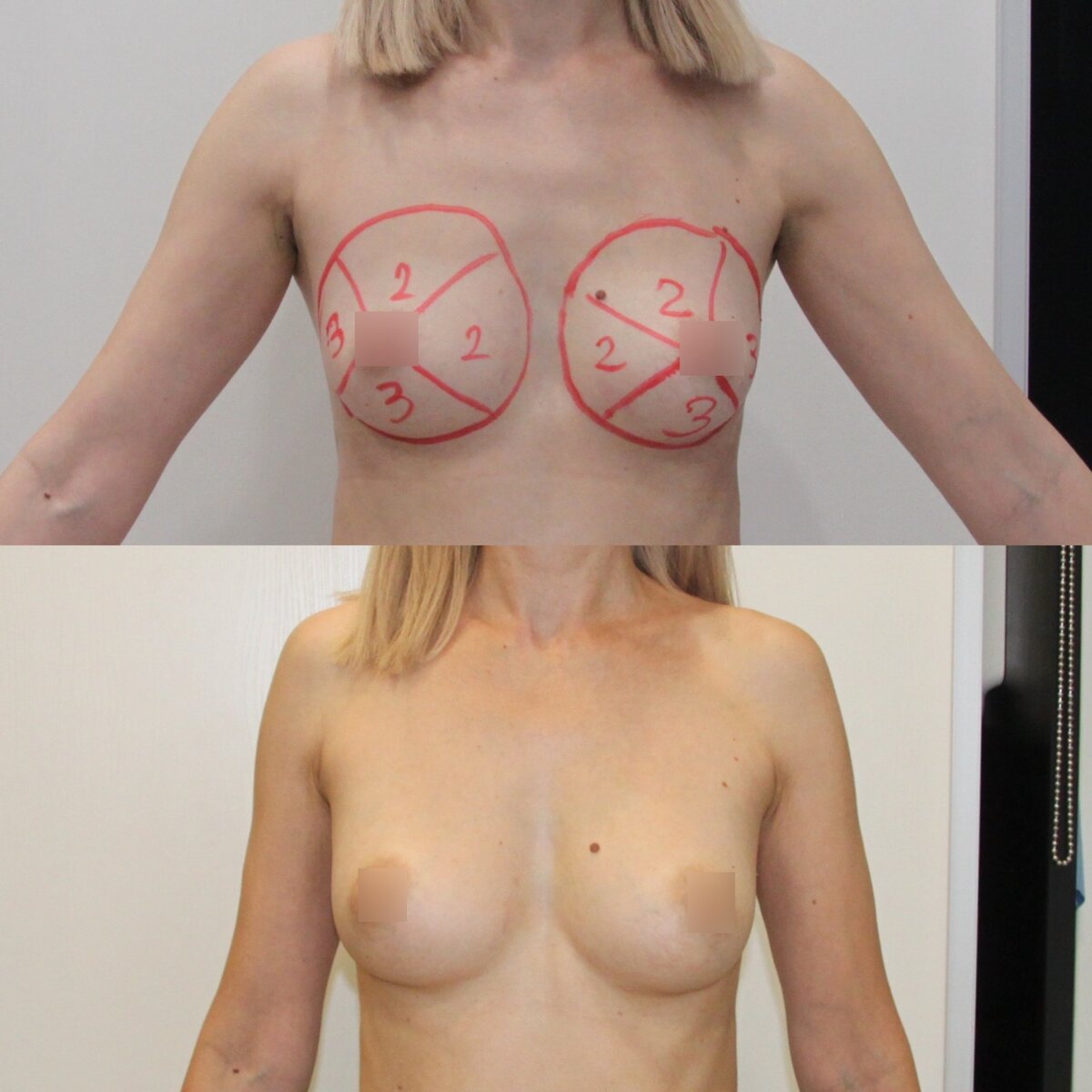 разрывы на грудях у женщин фото 70