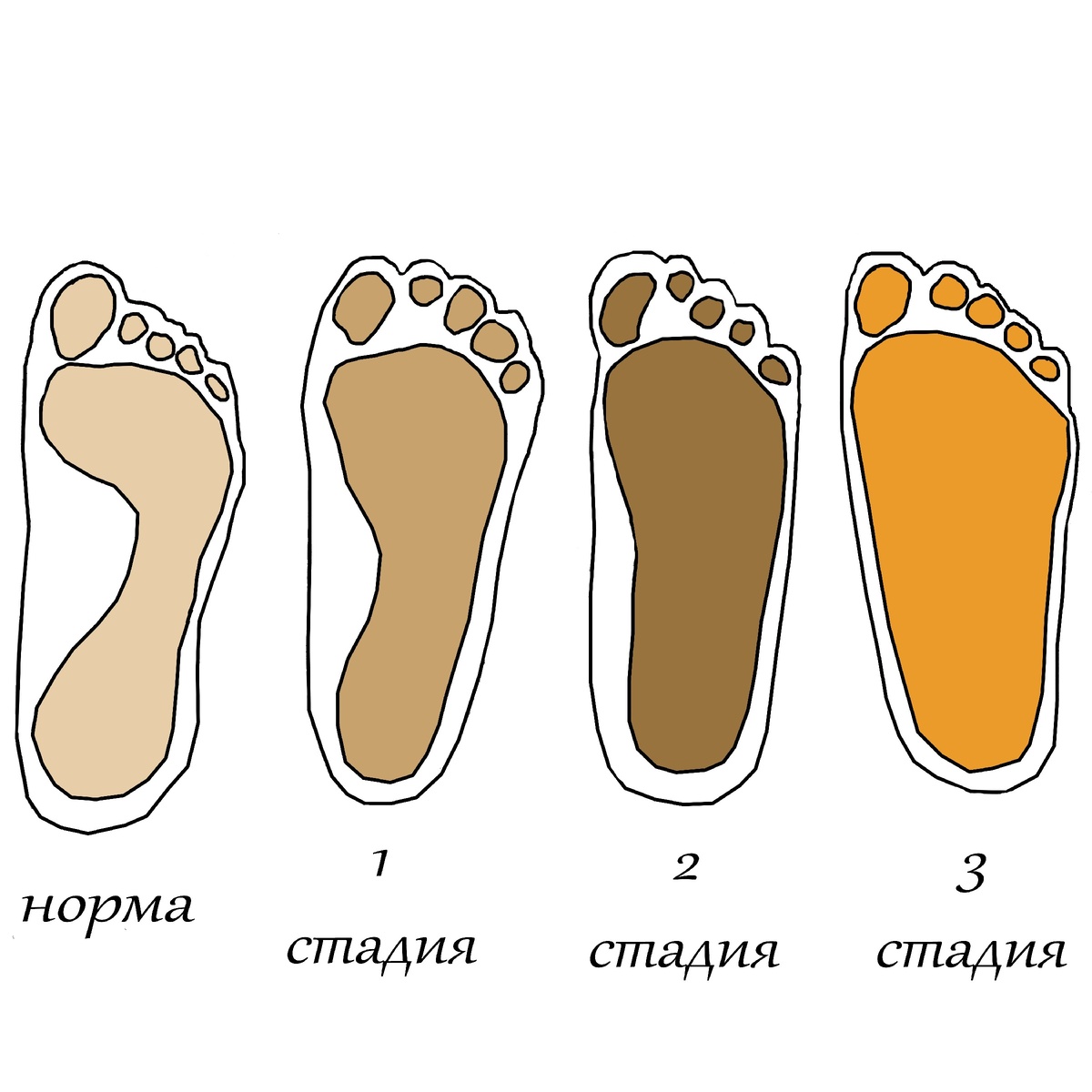 Определить стадию плоскостопия можно по отпечатку ноги