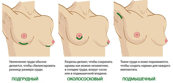 Фото-иллюстрация, какие доступы постановки импланта существуют