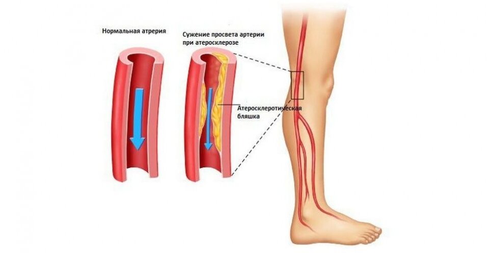 Атеросклероз сосудов нижних конечностей