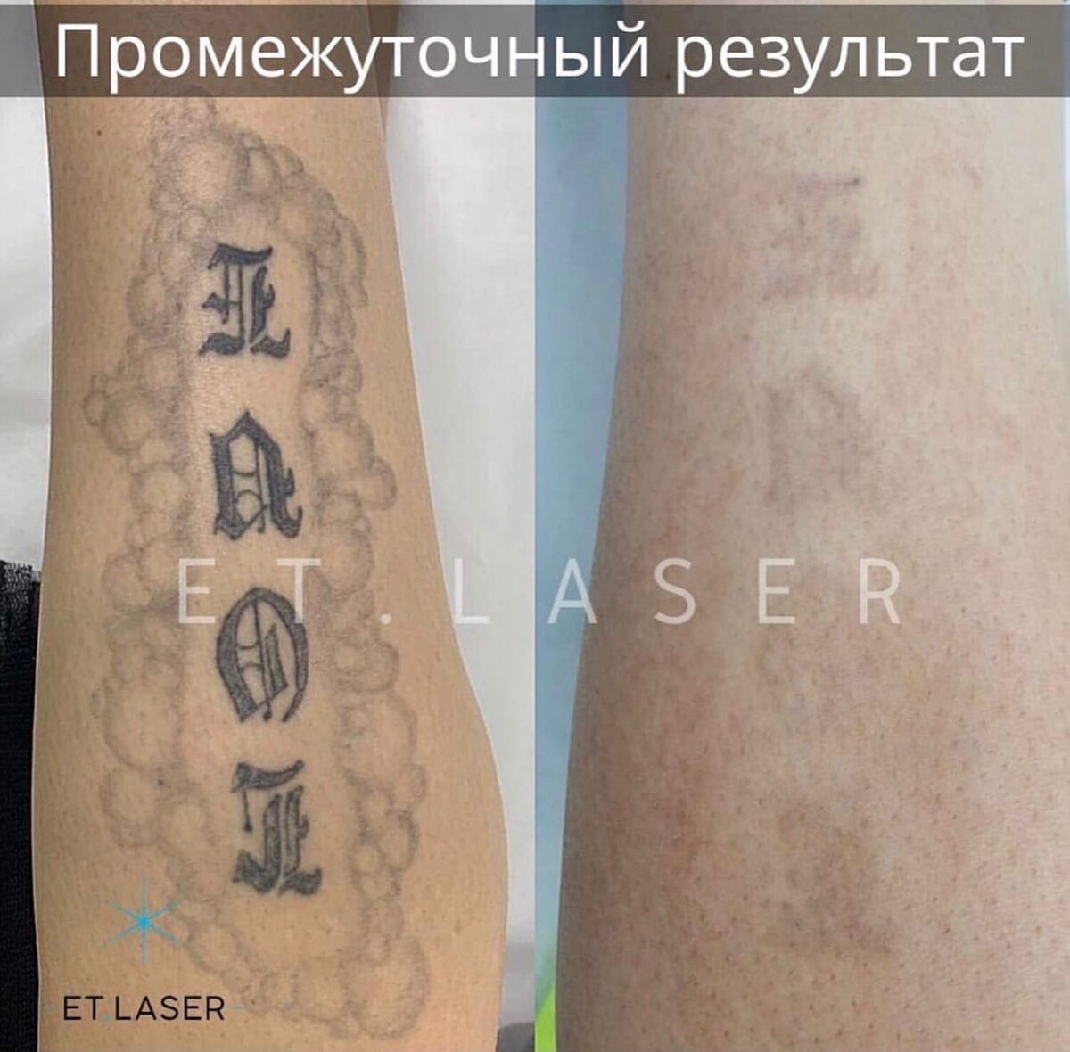 Лазерное удаление татуировок