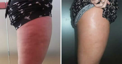 Эффективная борьба с целлюлитом