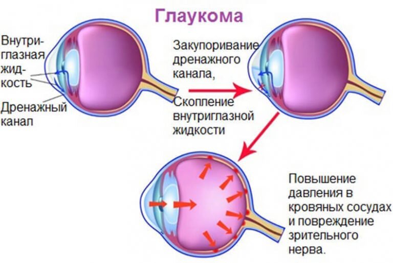 Медицина глаукома