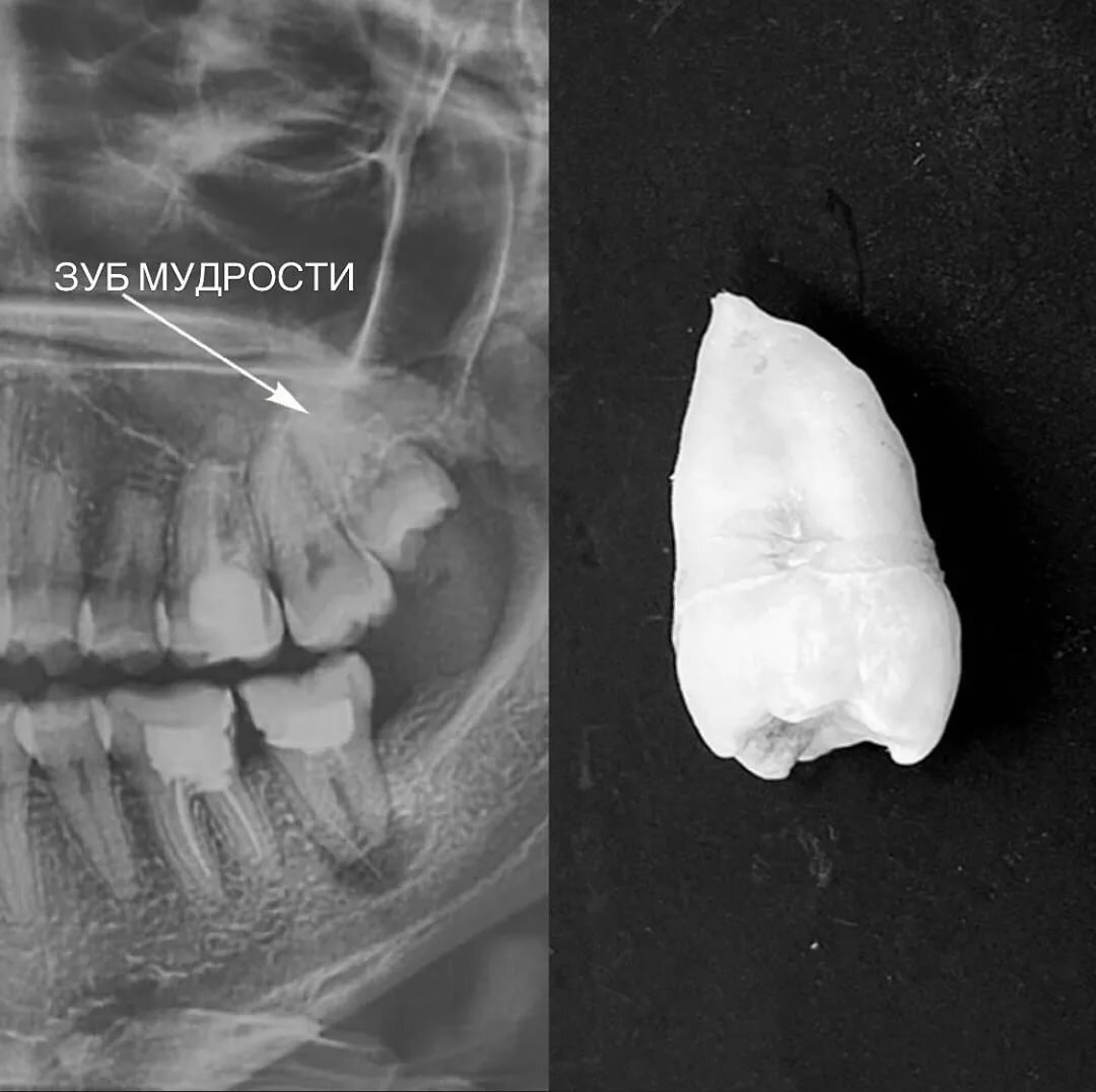 Зуб мудрости 8 фото