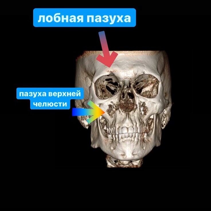 Это значит, что, делая КТ, мы захватываем обязательно и сустав, и даже лобные пазухи. 