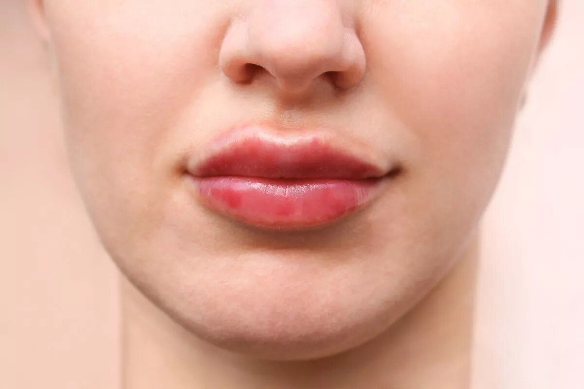 Увеличение губ усы гиалуроновые