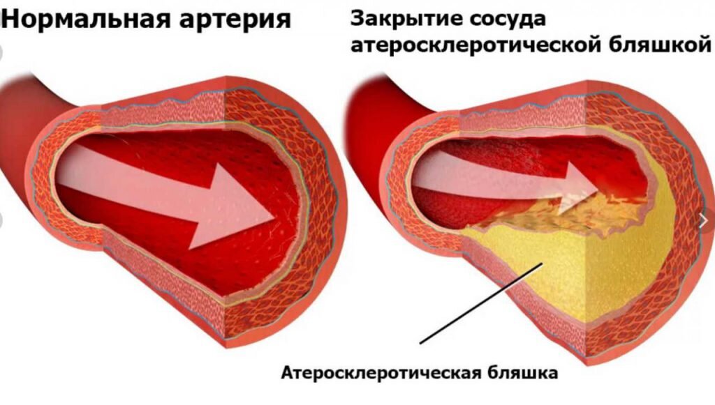 Отдел атеросклероза. Степени атеросклероза аорты. атеросклероз иллюстрация. атеросклеротическая бляшка в аорте рисунок.