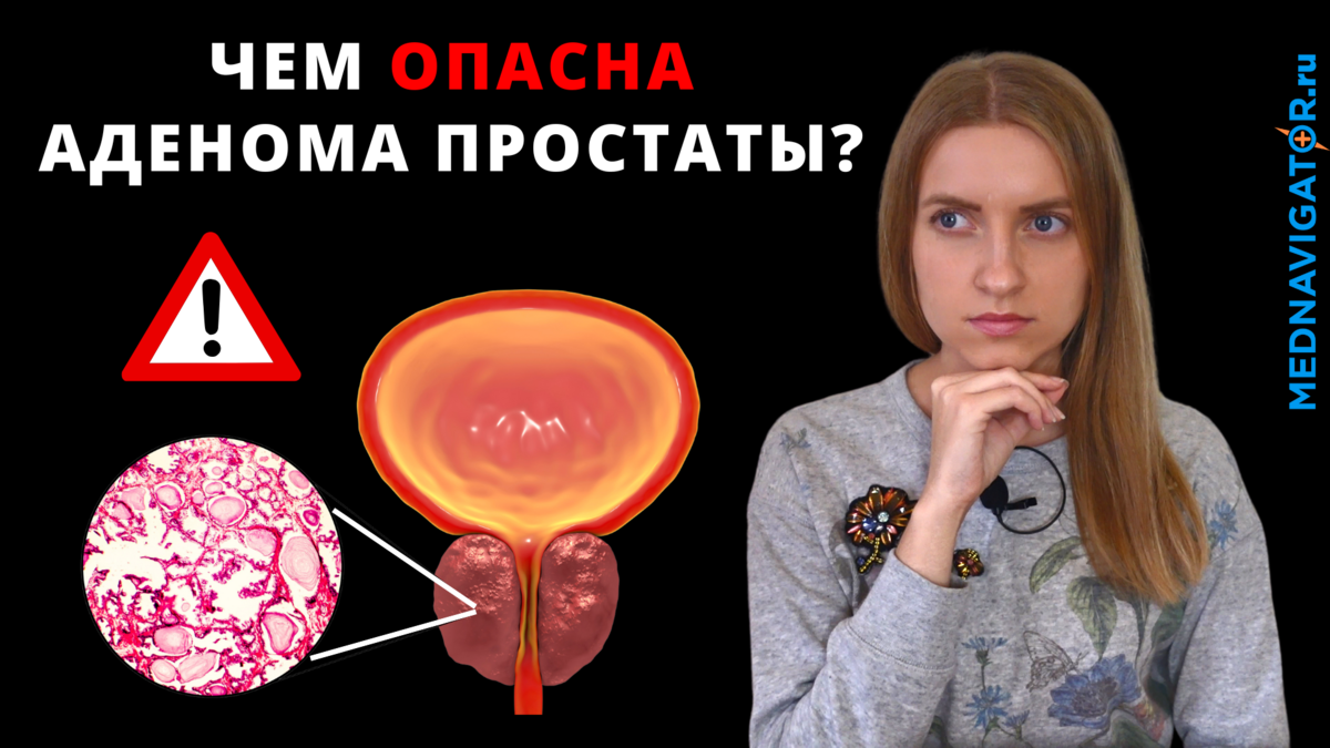 АДЕНОМА ПРОСТАТЫ - что это? Суть, причины, симптомы, диагностика и ...
