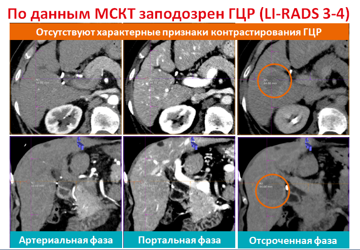 Гцр печени. Злокачественные новообразования.