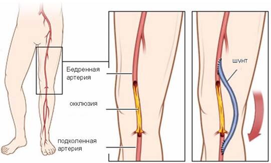Аорто – бедренное шунтирование