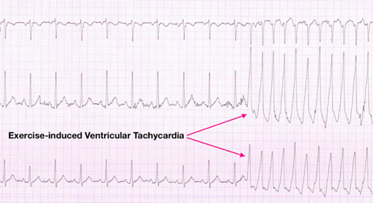 Проявившаяся под нагрузкой тахикардия