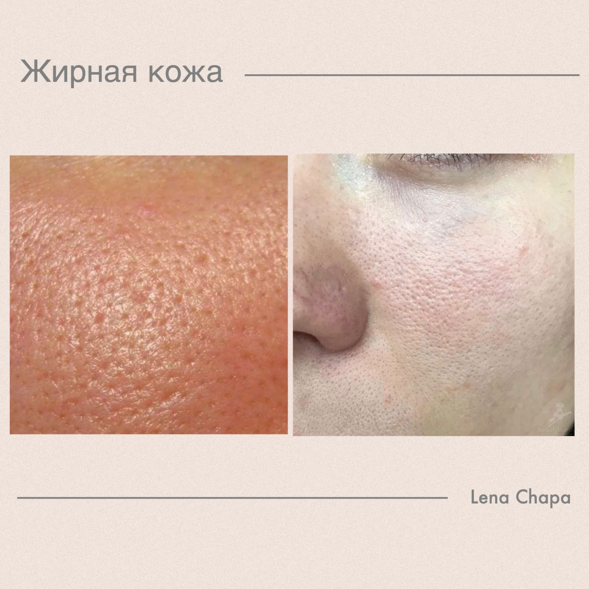 Как выглядит жирная кожа Жирная кожа лица и головы. уход за жирной кожей. лечение жирной кожи