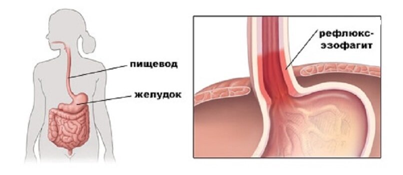 Заброс в пищевод симптомы и лечение. Эрозивный рефлюкс-эзофагит. Эзофагита эрозивного рефлюкс-эзофагита. Эрозивный гасстральный эзофагит.