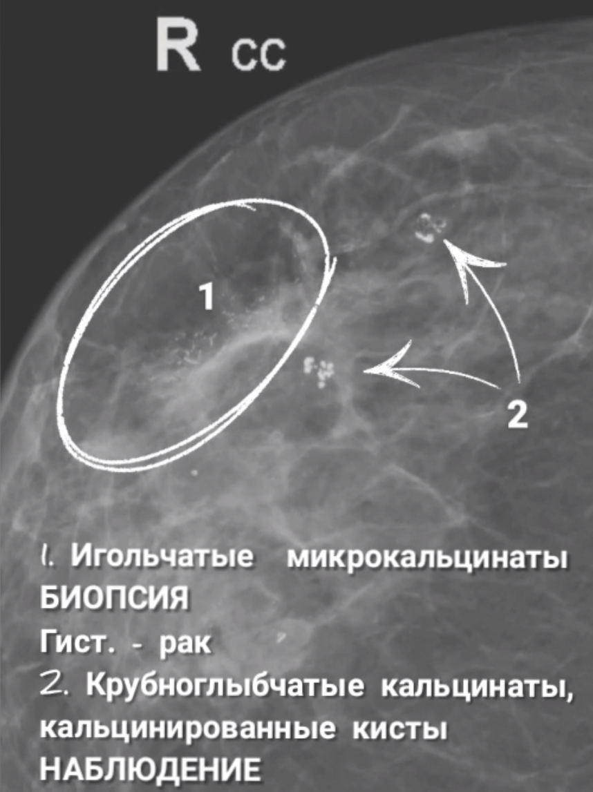 Микрокальцинаты в молочной Микрокальцинаты в молочной