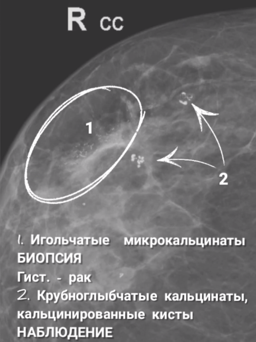 Кальцинаты молочных желез