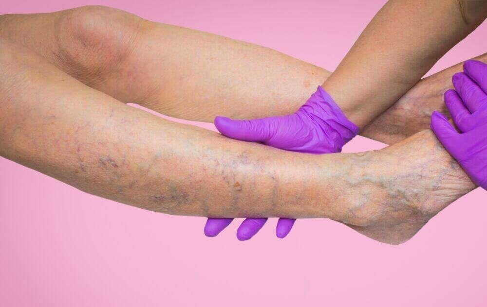 сосуды на ногах