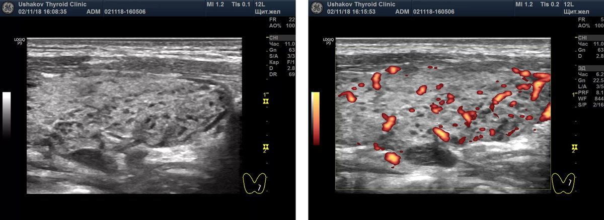 Слева снимок показывает: в доле щитовидной железы виден крупный сегмент, в котором множество долек содержат темную (гипоэхогеную) ткань - признак разрушения ткани ЩЖ и присутствия иммунных клеток лимфоцитов. Интенсивность кровотока в этом сегменте доли увеличена до умеренной степени (снимок справа). Из монографии А.В. Ушакова.