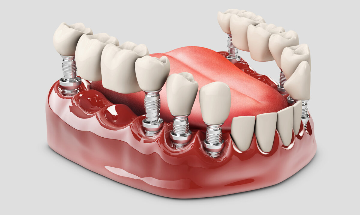 зубной мост на имплантах