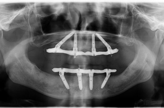 как выглядел протез "все на 4"