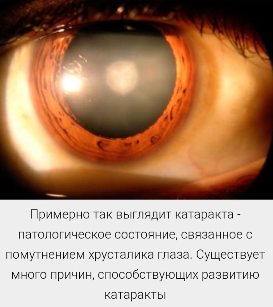 старческая(сенильная)катаракта. постувеальная катаракта. миопизирующая катаракта. катаракта глаза пелена. катаракта глаза пелена.