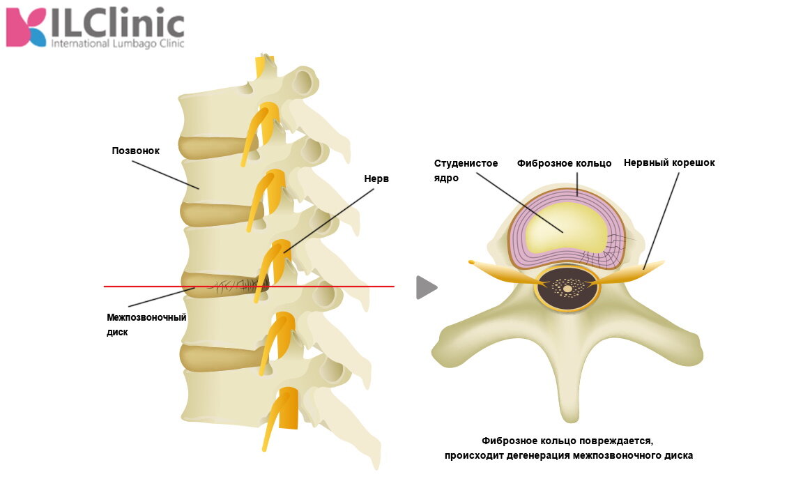 Грыжа межпозвонковых дисков презентация