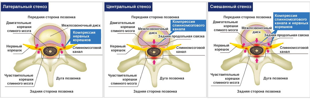 Дегенеративный стеноз шейного отдела