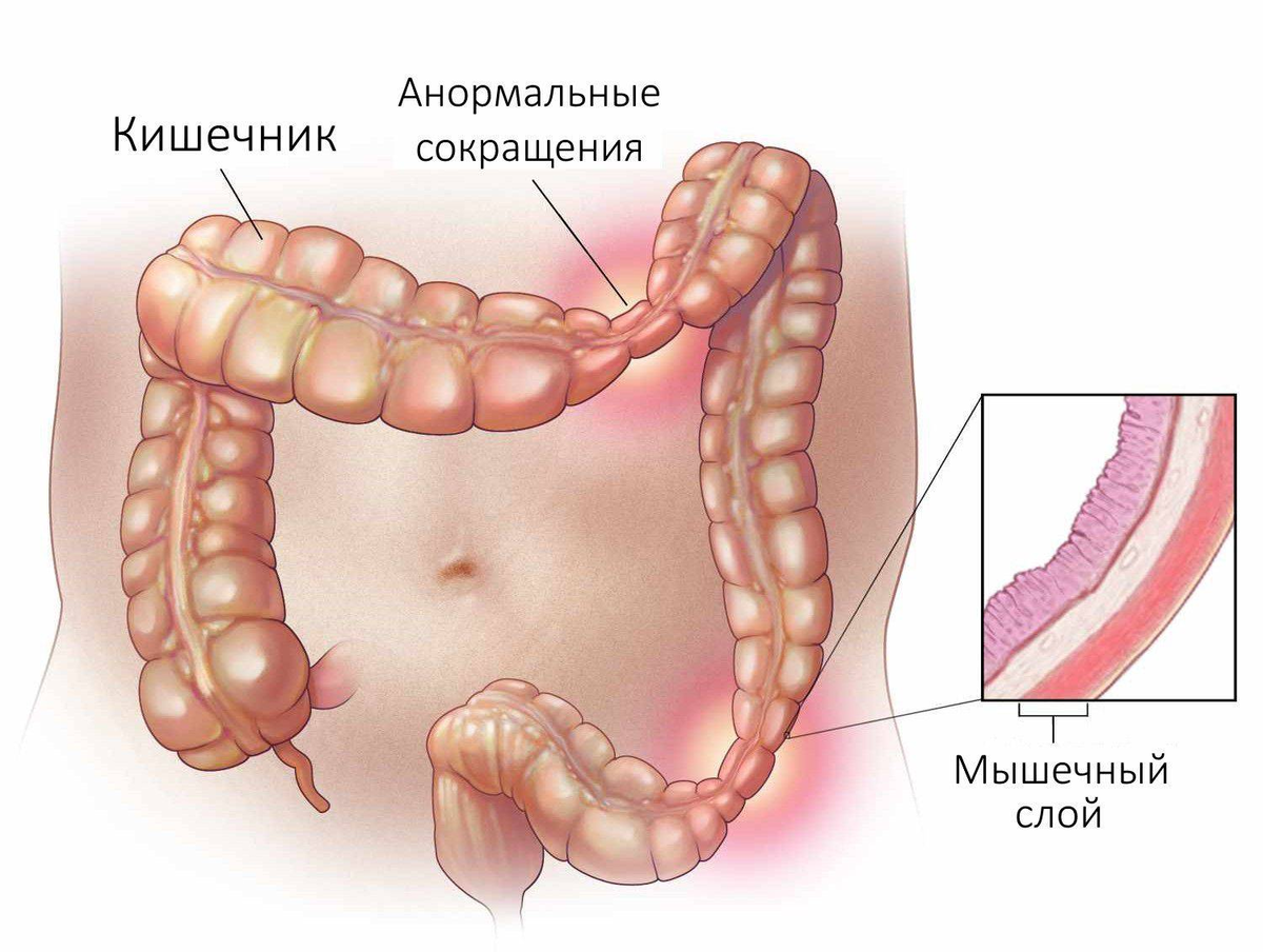 Синдром раздражения Толстого кишечника. Синдром раздраженного кишечника (СРК) симптомы. Синдром раздраженного кишечника толстой кишки симптомы. Синдром раздражённо го кишечника.