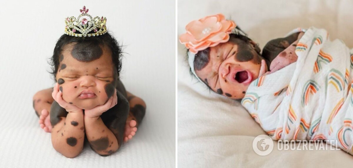 В США родилась девоча с редкой болезнью