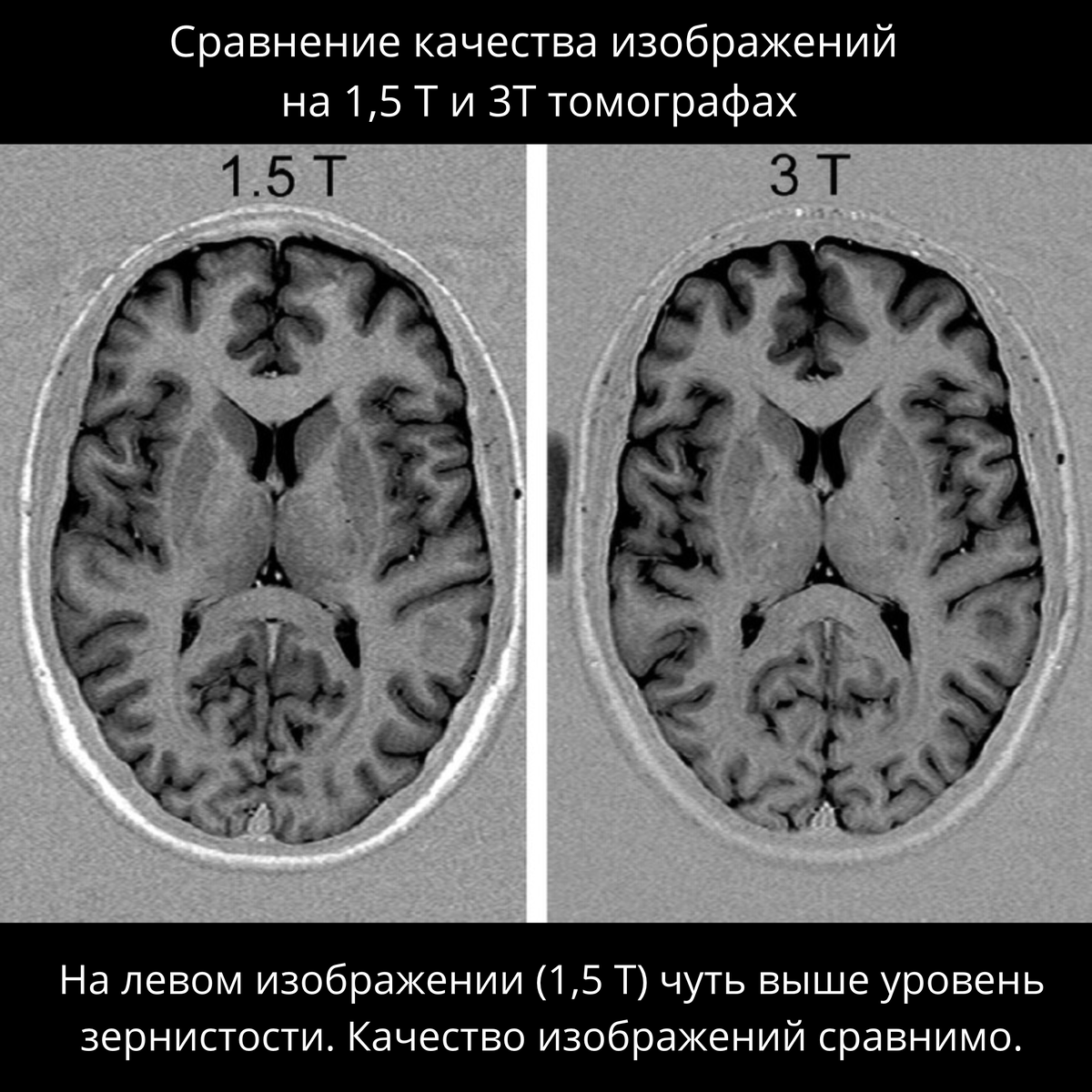 Мрт мозга 1 тесла